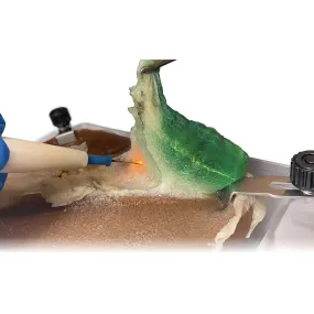 Cholecystectomy Model